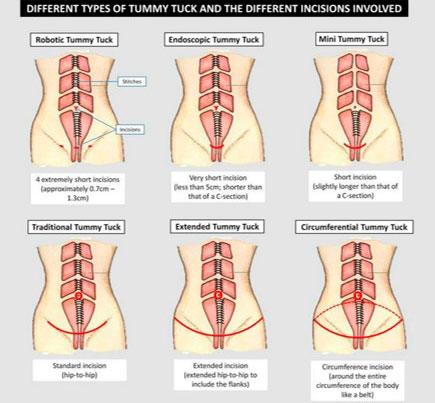 Types of Tummy Tuck / Abdominoplasty